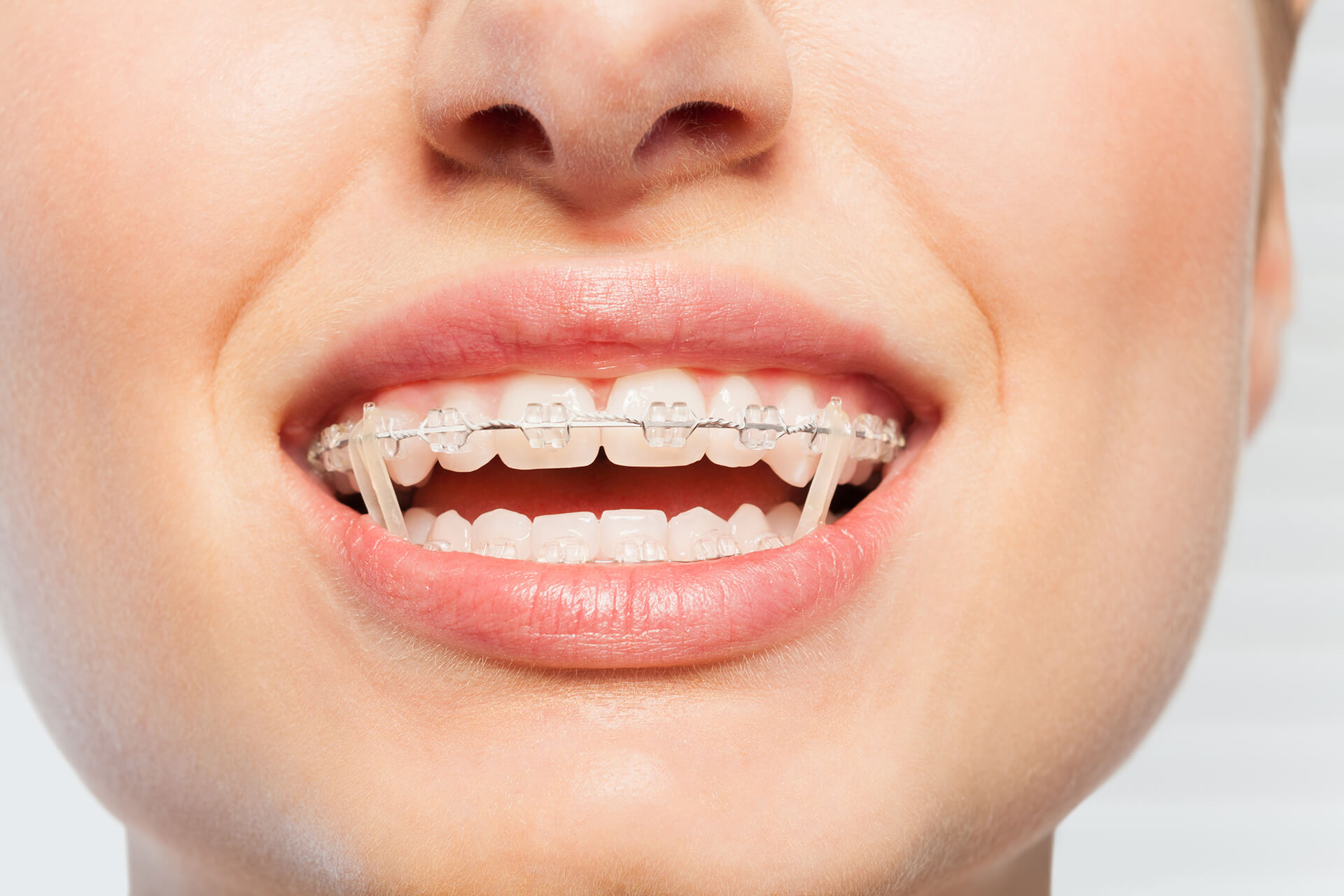 Elastics (Rubber Bands) in Orthodontic Treatment